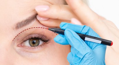 Augenlidkorrektur