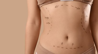 Bauchstraffung: in Kombination mit einer Vaser®-Fettabsaugung 