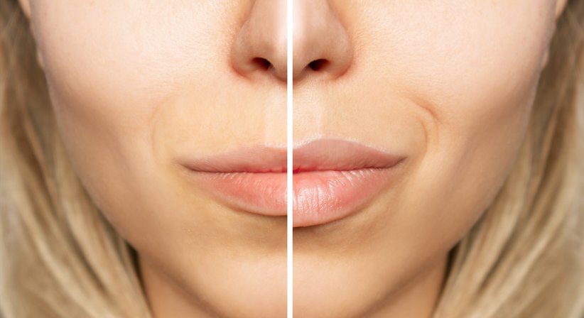 Lippen aufspritzen (Lippenkorrektur) - Doz. Dr. Georg Huemer - Plastischer Chirurg Linz 4020