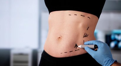 Fettabsaugung mit Vaser®-Technik