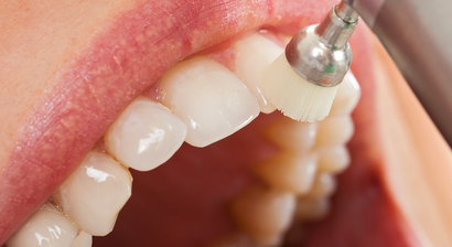 Professionelle Zahnreinigung