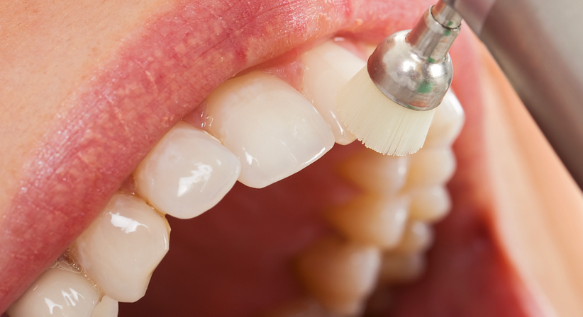 Professionelle Zahnreinigung - Dr. Maike Jörck, MSc. - Zahnärztin Salzburg 5020