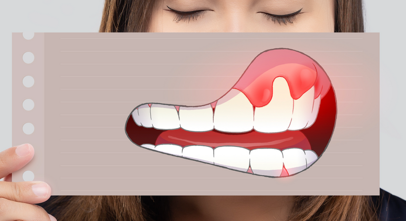 Zahnfleischbehandlungen - Dr. Maike Jörck, MSc. - Zahnärztin Salzburg 5020