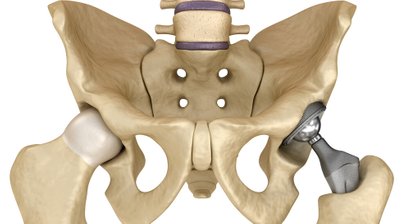 Endoprothetik der Hüfte (Hüft-TEP)