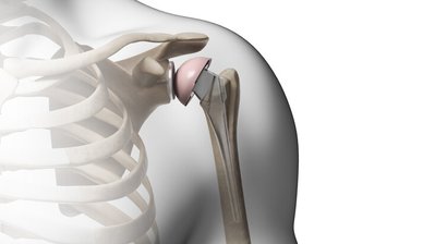 Schulterprothese (künstliches Schultergelenk)