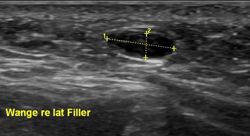 Ultraschallgezielte Auflösung von Hyaluronsäure-Filler mittels Hylase - Dr. Sonja Lattenmayer-Meizer - Radiologin Perchtoldsdorf bei Wien 2380