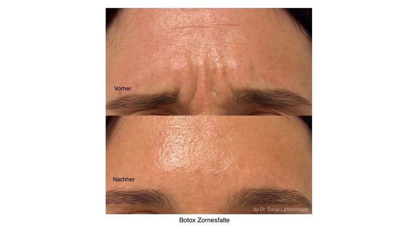 Faltenunterspritzung bzw. Gesichtslifting mit Hyaluronsäure und Botox, ultraschallkontrolliert - Dr. Sonja Lattenmayer-Meizer - Radiologin Perchtoldsdorf bei Wien 2380