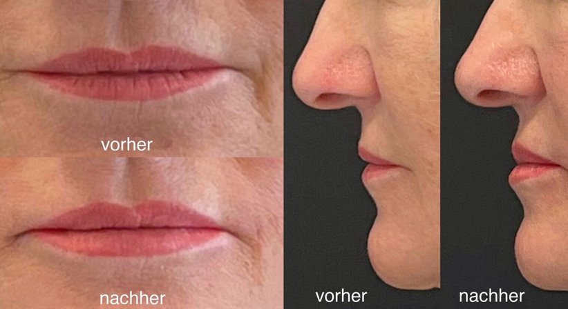 Faltenunterspritzung bzw. Gesichtslifting mit Hyaluronsäure und Botox, ultraschallkontrolliert - Dr. Sonja Lattenmayer-Meizer - Radiologin Perchtoldsdorf bei Wien 2380