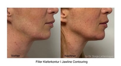 Faltenunterspritzung bzw. Gesichtslifting mit Hyaluronsäure und Botox, ultraschallkontrolliert