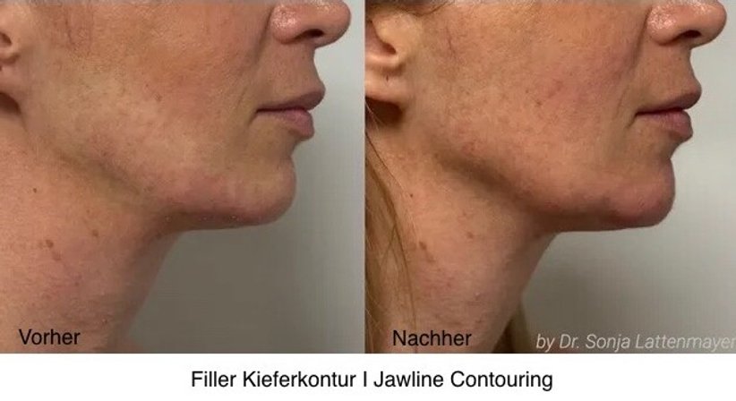 Hyaluronsäure-Filler - Dr. Sonja Lattenmayer-Meizer - Radiologin Perchtoldsdorf bei Wien 2380