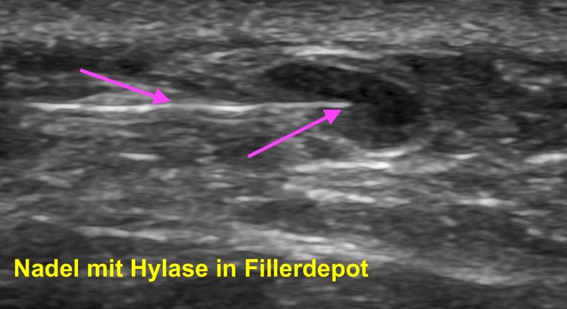 Ultraschallgezielte Auflösung von Hyaluronsäure-Filler mittels Hylase - Dr. Sonja Lattenmayer-Meizer - Radiologin Perchtoldsdorf bei Wien 2380