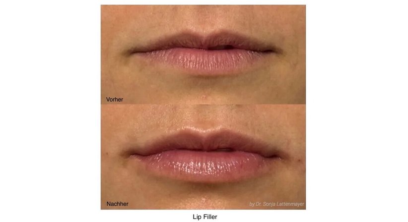 Faltenunterspritzung bzw. Gesichtslifting mit Hyaluronsäure und Botox, ultraschallkontrolliert - Dr. Sonja Lattenmayer-Meizer - Radiologin Perchtoldsdorf bei Wien 2380