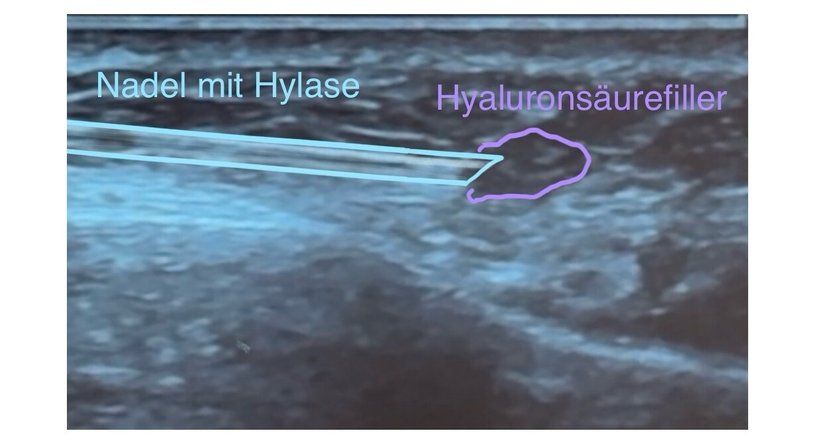 Faltenunterspritzung bzw. Gesichtslifting mit Hyaluronsäure und Botox, ultraschallkontrolliert - Dr. Sonja Lattenmayer-Meizer - Radiologin Perchtoldsdorf bei Wien 2380