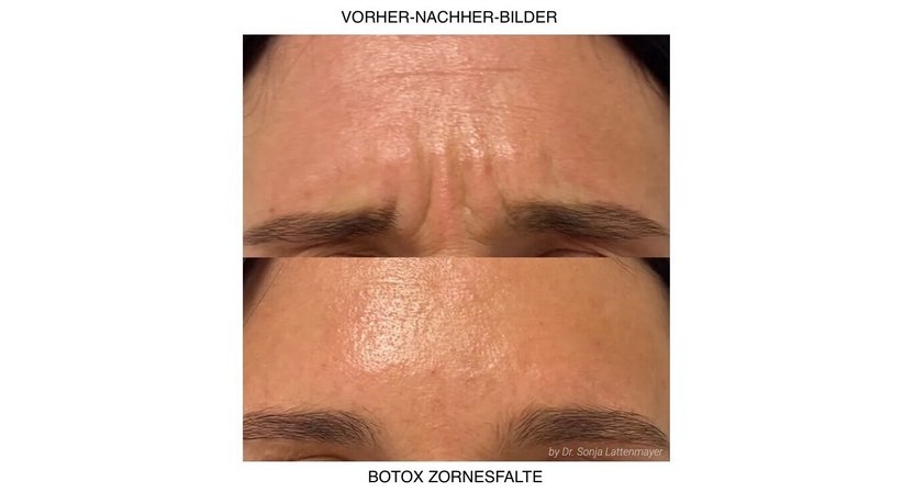 Faltenmilderung & Gesichtslifting mittels BTX - Dr. Sonja Lattenmayer-Meizer - Radiologin Perchtoldsdorf bei Wien 2380