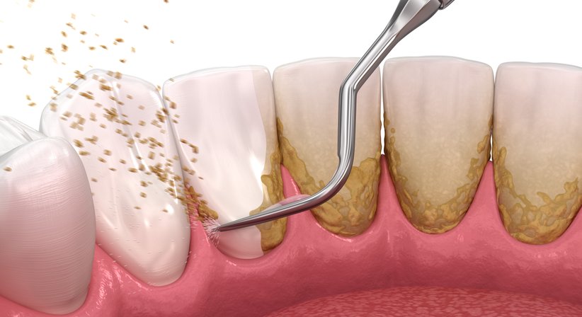 Professionelle Mundhygiene - Dr. Sehdi Sarmini - Zahnarzt Salzburg 5020