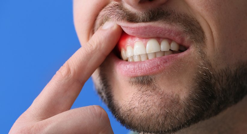 Parodontalbehandlung - Dr. Sehdi Sarmini - Zahnarzt Salzburg 5020