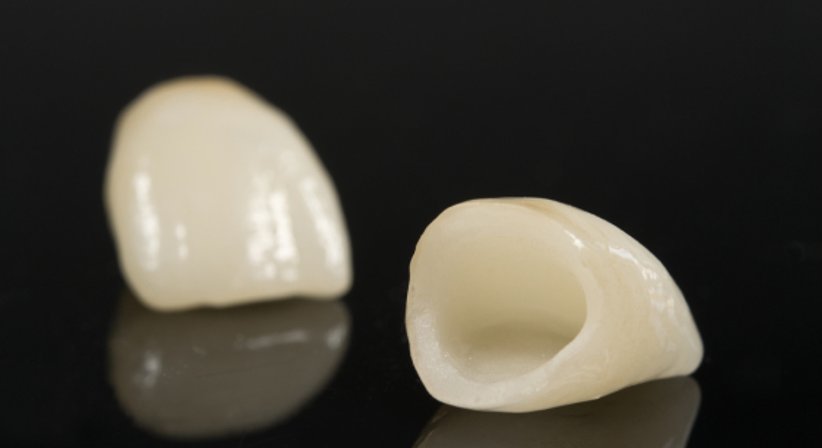 Kronen - Dr. Lukas Fürhauser - Zahnarzt Purkersdorf 3002