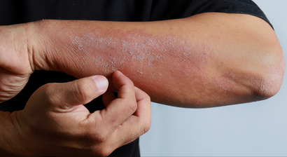 Entzündliche Hauterkrankungen