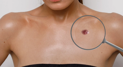  Behandlung von Hämangiomen (Blutschwämmchen)