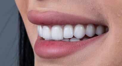 Kronen- und Brückenversorgung