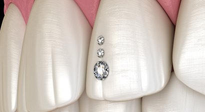 Zahnschmuck