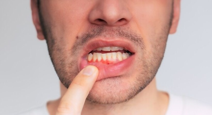 Parodontalbehandlung - Dr. Katalin Gritsch-Mártyán - Zahnärztin Wien 1220