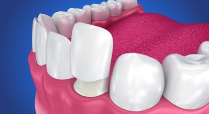 Veneers (keramische Verblendschalen)