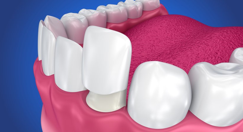 Veneers (keramische Verblendschalen) - Dr. Harald Hampel - Zahnarzt Wals 5071