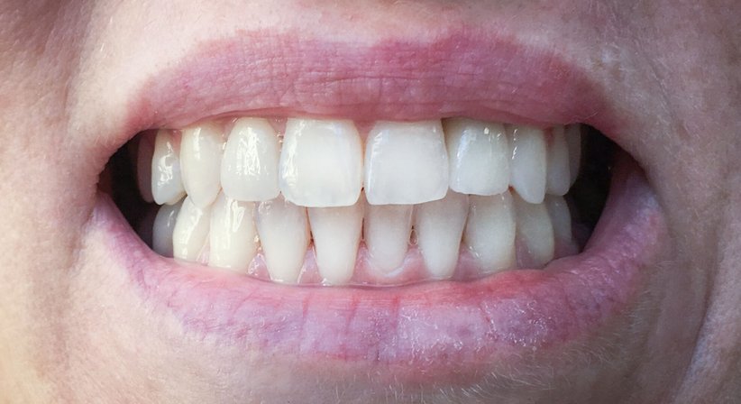 Ästhetische Frontzahnversorgungen - Dr. Katrin Köllensperger - Zahnärztin Wien 1190