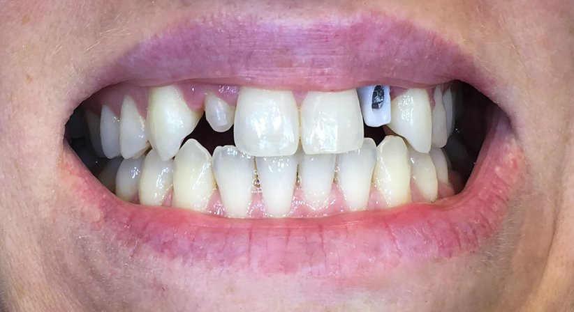 Ästhetische Frontzahnversorgungen - Dr. Katrin Köllensperger - Zahnärztin Wien 1190