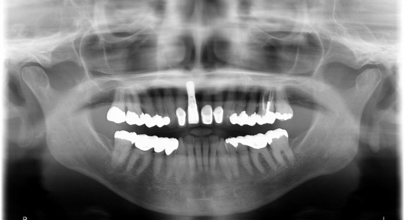 Implantatprothetik - Dr. Katrin Köllensperger - Zahnärztin Wien 1190