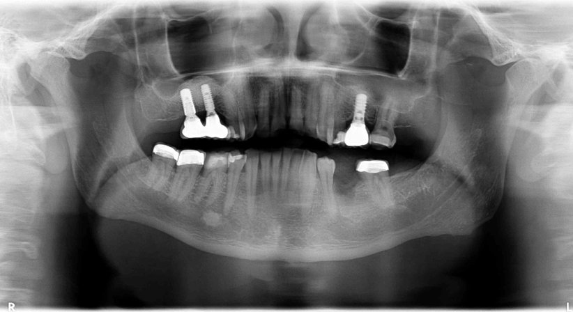 Implantatprothetik - Dr. Katrin Köllensperger - Zahnärztin Wien 1190