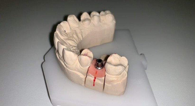 Implantatprothetik - Dr. Katrin Köllensperger - Zahnärztin Wien 1190