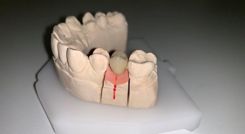 Implantatprothetik - Dr. Katrin Köllensperger - Zahnärztin Wien 1190