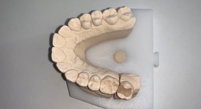 Inlays und Kronen für Seitenzahnrestaurationen