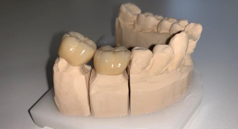 Inlays und Kronen für Seitenzahnrestaurationen - Dr. Katrin Köllensperger - Zahnärztin Wien 1190