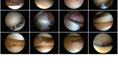 Arthroskopie (Knie, Schulter)