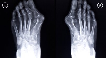 Hallux valgus