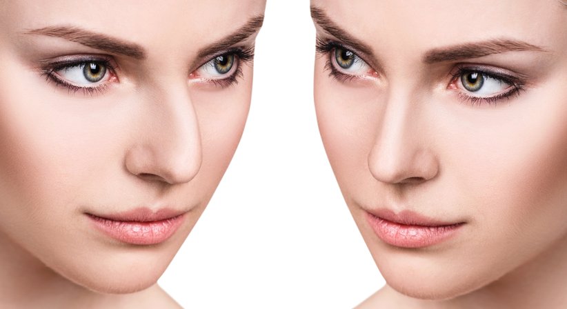 Nasenkorrektur - Priv.-Doz. Dr. Stefan Hacker, FEBOPRAS - Plastischer Chirurg Wieselburg 3250