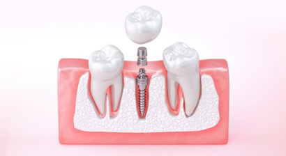 Prothetische Rehabilitation