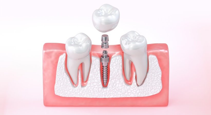 Prothetische Rehabilitation - Dr. Winfried Wiesinger - Zahnarzt Amstetten 3300