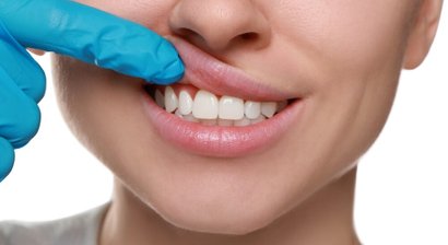 Ästhetische Zahnfleischplastik