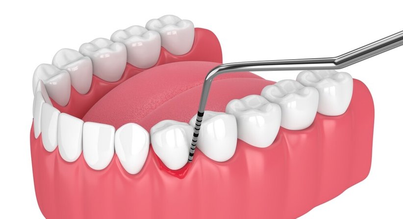 Parodontologie - Dr. Winfried Wiesinger - Zahnarzt Amstetten 3300
