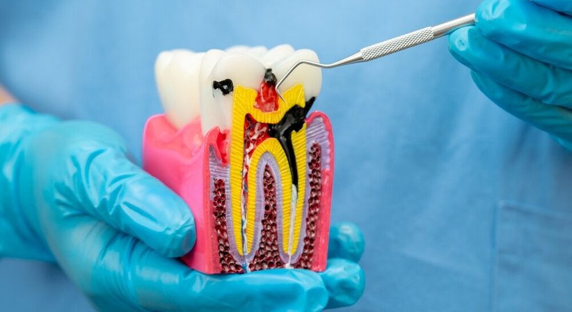 Endodontie - Dr. Winfried Wiesinger - Zahnarzt Amstetten 3300