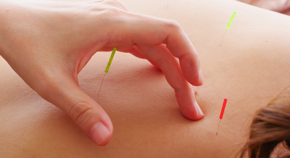 Akupunktur und Naturheilmedizin
