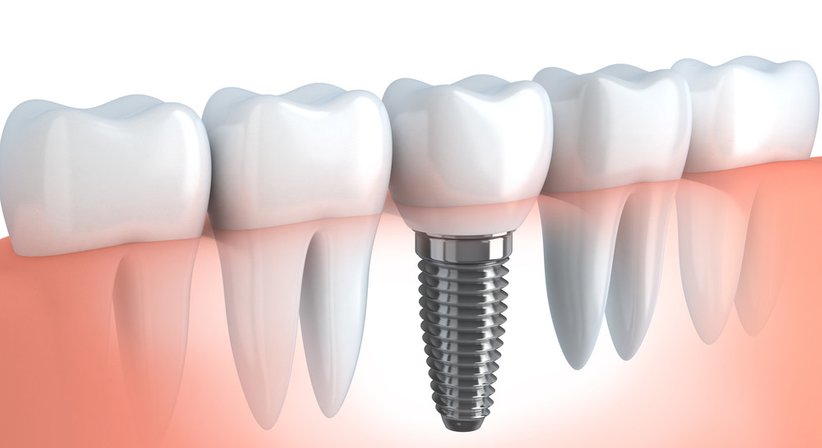 Implantate / Knochenaufbauten - Dr. med. dent. Thomas Huber - Zahnarzt Wien 1100