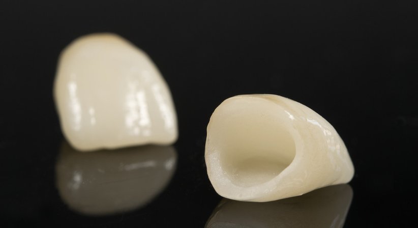 Kronen / Brücken - Dr. med. dent. Thomas Huber - Zahnarzt Wien 1100