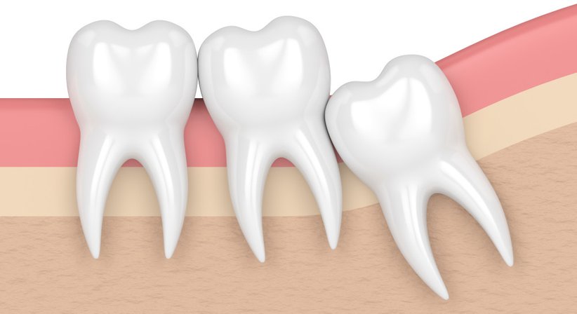 Orale Chirurgie – kleine operative Eingriffe im Mundraum - DDr. Florian Six - Zahnarzt Wels 4600