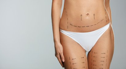 Fettabsaugung (Liposuktion)