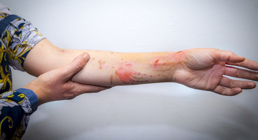 Narbenkorrekturen - Dr. Günter Schmid - Plastischer Chirurg Feldkirch 6800